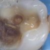 dents