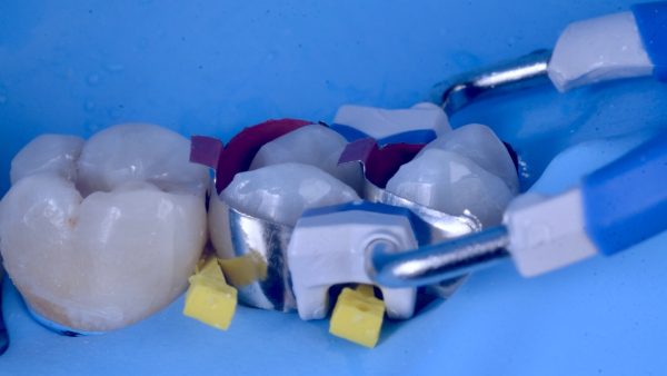 Le traitement esthétique postérieur – Image 2